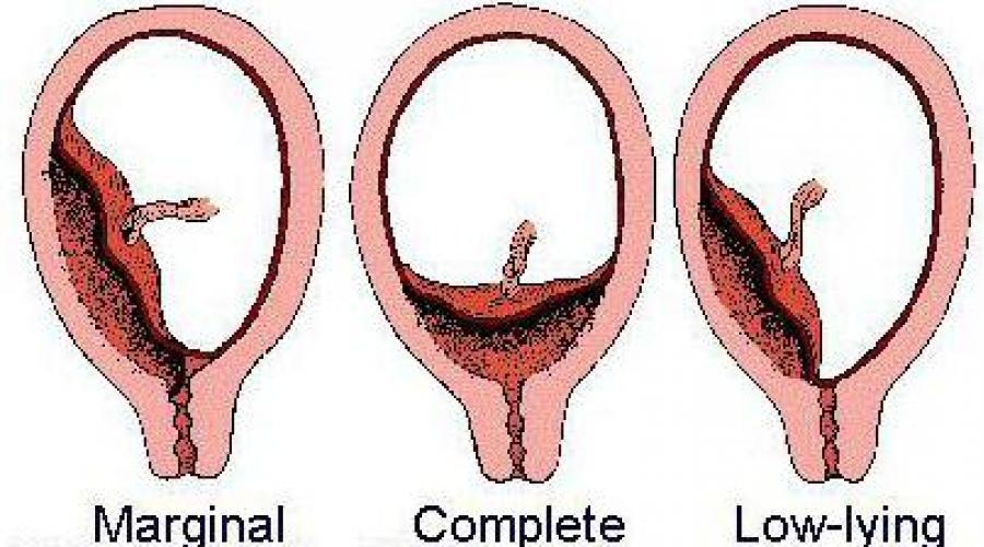 Placenta previa în timpul sarcinii: ce este, clasificare și opțiuni de livrare.  Probleme în timpul sarcinii: totul despre placenta previa