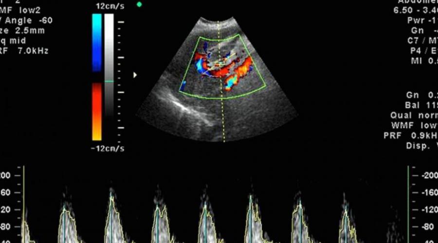 Ultrazvuk s dopplerografií během těhotenství: normy a interpretace.  Popis dopplerovského vyšetření v těhotenství Co je to DPM v těhotenství na ultrazvuku